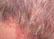 Inflammation and Hair Loss