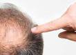 Dealing With Negative Reactions to Hair Loss
