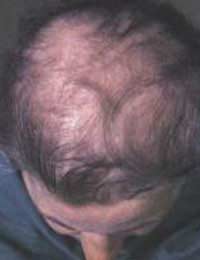 Hypothrichosis Simplex Hair Loss Child