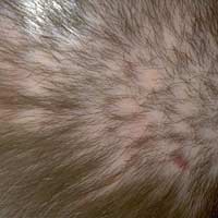 Pseudopelade Alopecia Hair Loss