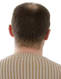 Hair Loss Male Pattern Baldness