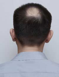 Alopecia Hair Loss Thinning Of Hair