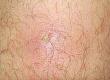 What is Folliculitis