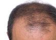 Scalp Damage and Hair Loss