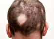 Scalp Reduction Surgery