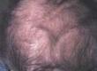 Understanding Hypotrichosis Simplex