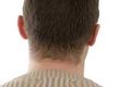 What Causes Male Pattern Baldness?