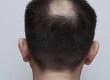 What is Alopecia?