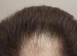 Partial Hair Loss