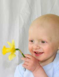 Hair Loss Children Alopecia Allergy