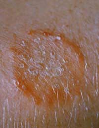 Ringworm Hair Loss Fungus Infection