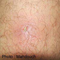 Folliculitis Hair Loss Follicle