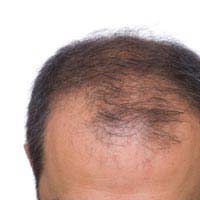 Hair Loss Impact Injury Head Scalp Burn