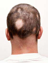 Scalp Reduction Surgery Hair Loss Bald