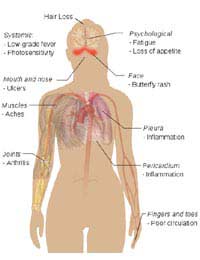 Lupus Hair Loss Autoimmune Disease