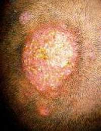 Kerion Celsi Ringworm Scalp Hair Loss