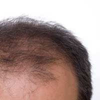 Receding Hair Hairline Thinning Style