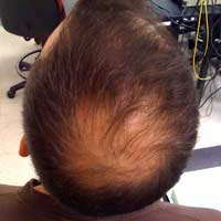 Hair Loss Causes Of Hair Loss Male
