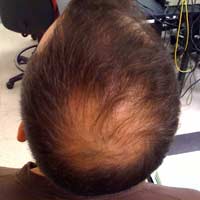 Diabetes Hair Loss Medicine Thinning