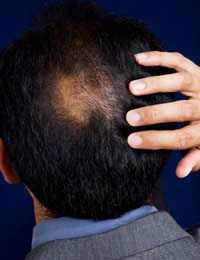 Poisoning Hair Loss Poison Sudden Hair