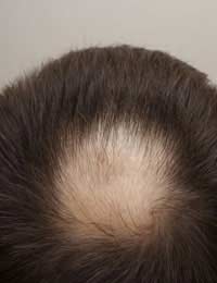 Bald Hair Loss Scalp Care Caring Skin