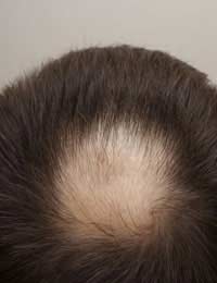 Hair Loss Hair Partial Hair Loss